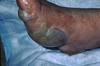 Bullous dermatophyte infection